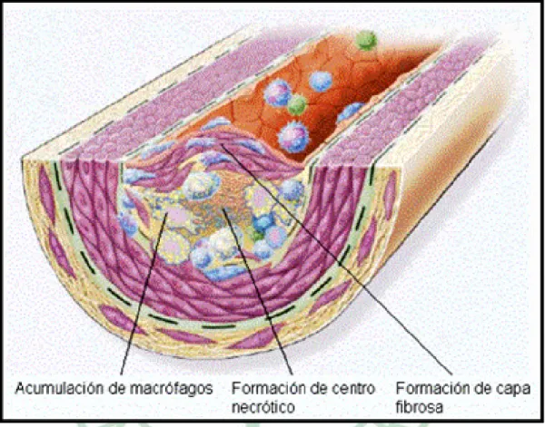 Fig. 2-3. Formation of an advanced, complicated lesion of atherosclerosis  (Ross, 1999)