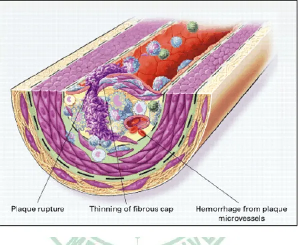 Fig. 2-4. Unstable fibrous plaques in atherosclerosis (Ross, 1999). 