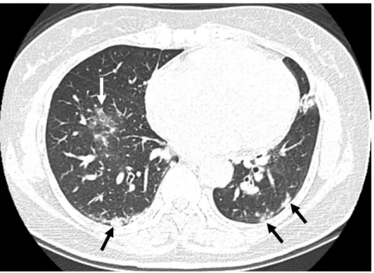 圖 3 胸部高解像力電腦斷層(94 年 6 月)，可發現兩側下肺葉呈現肋膜下毛玻璃 樣變化(subpleural ground glass opacity)(箭號)。