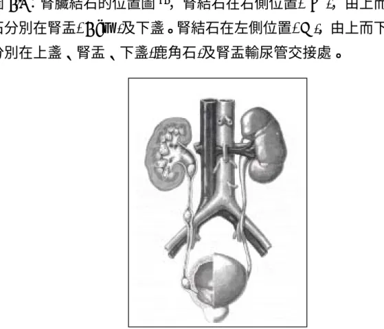 圖 2.2：輸尿管結石的位置圖 75 ，結石在右側位置，由上而下結石分 別:  上段輸尿管結石、中段輸尿管結石、下段輸尿管結石。 