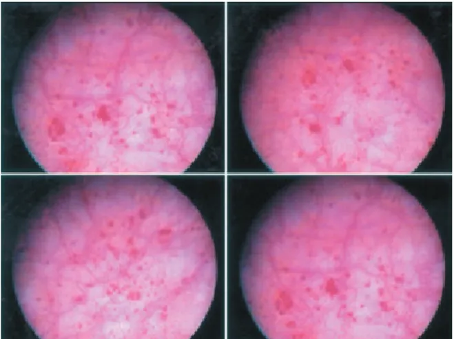 圖 2： 膀胱鏡檢下的Hunner's ulcer（引用來源：Campbell-Walsh  Urology 10th edition）