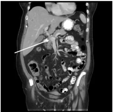 Figure  2.  Coronal  section  of  CT  scan  demonstrates  a  dilated superior mesenteric vein near the level of the  con-fluence.