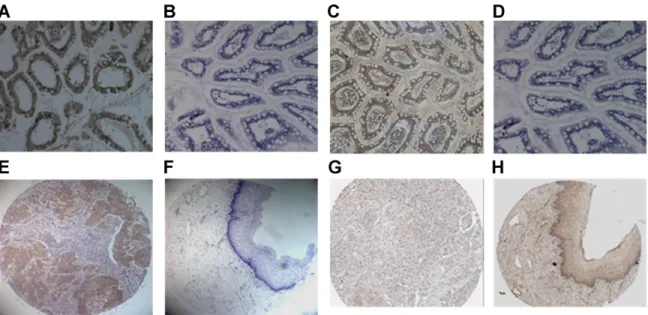 Fig. 1. Immunohistochemical expression of MMP-2 and TIMP-2 protein in representative normal   and   squamous   cell   carcinoma   (SCC) tissue cores in tissue microarrays of uterine cervix