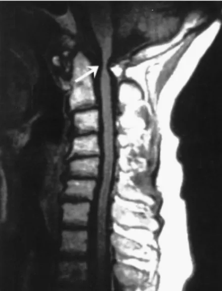 Fig. 3. Three-dimensional CT demonstrates markedly increased predental space, measuring 19.78 mm (black arrow), and marked spinal canal stenosis due to cleft of the posterior arch of C-1 and atlantoaxial subluxation (white arrow).