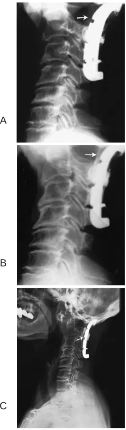 Fig. 5. A: Immediate post-operative plain radiograph of the cervical spine demonstrates widening canal after decompression and fusion; B: The follow-up radiograph of the cervical spine 6 months later, and C: Successful fusion of the occipital bone to C-3 v