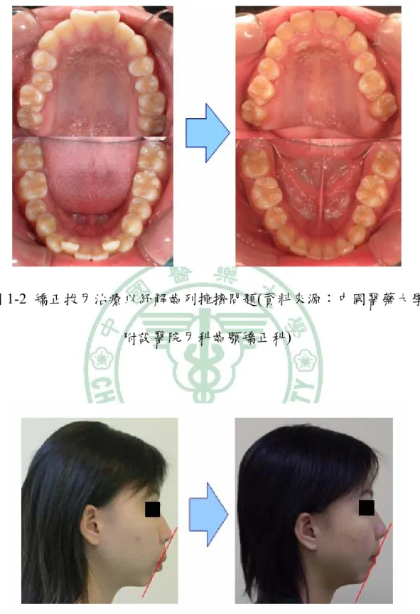 圖 1-2  矯正拔牙治療以紓解齒列擁擠問題(資料來源：中國醫藥大學 附設醫院牙科齒顎矯正科) 
