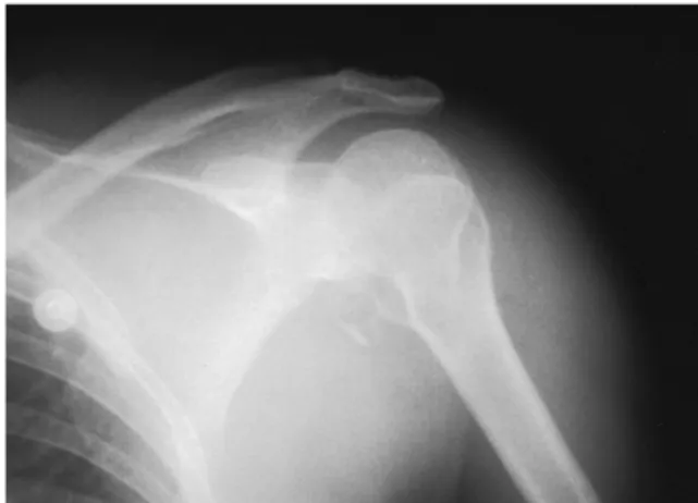 Fig. 2. Anteroposterior X-ray of the left shoulder shows fracture of the proximal humerus.
