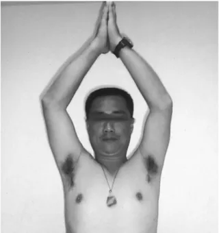 Fig. 7. Anterior view of the patient shows good range of motion of both shoulders.