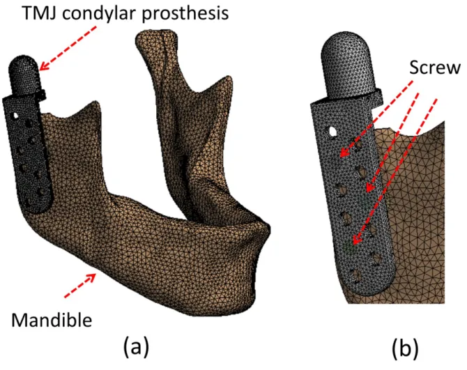 Fig. 1. Finite element model of the mandible and TMJ condylar prosthesis: (a) whole model; (b) closed view.