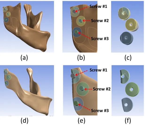 Fig. 3. Solid model: (a) whole cortical bone with 3 inserted screws; (b) closed view of (a); (c) cortical bone surrounding the screws; (d) whole cancellous bone with 3 inserted screws; (e) closed