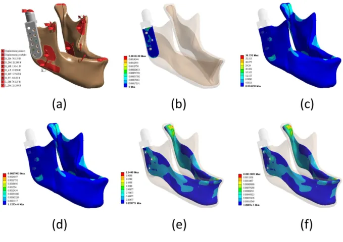 Fig. 4 Finite element simulation of the INC model: (a) constraint and INC; (b) relative micromotion between the stem and bone; (c) von Mises stress of the whole cortical bone; (d) von Mises strain of the whole cortical bone; (e) von Mises stress of the who
