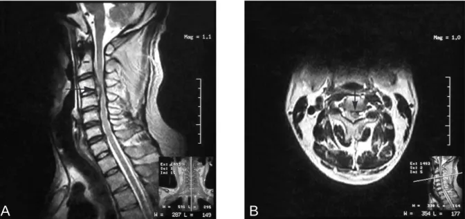 Fig. 1. Preoperative MRI shows a large left extradural paramedian C3-C4 disc herniation, with cord compression