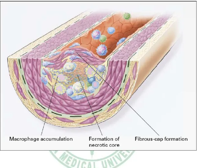 Fig. 1-3. Formation of an advanced, complicated lesion of atherosclerosis    (Ross, 1999)