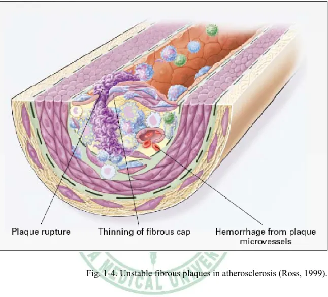 Fig. 1-4. Unstable fibrous plaques in atherosclerosis (Ross, 1999). 