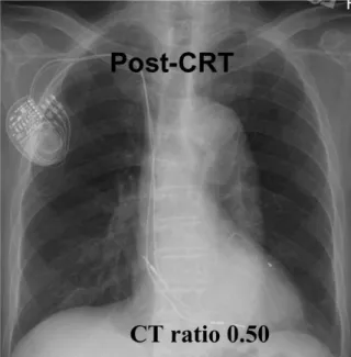 Fig. 1. Chest roentgenograms showing reduction in heart sizes after cardiac resynchronization therapy (CRT)