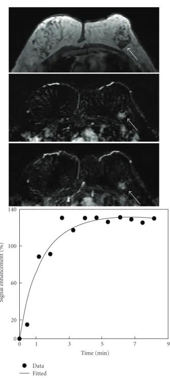 Figure 2: A 55-year-old woman with intermediate-grade pure DCIS. Axial precontrast T1-weighted image (top), postcontrast subtraction image (middle), and maximum intensity projection (bottom) show several foci in the right breast