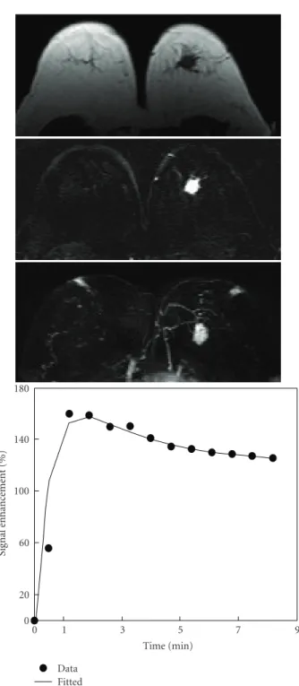 Figure 4: A 39-year-old woman with high-grade pure DCIS. Axial precontrast T1-weighted image (top), postcontrast subtraction image (middle), and maximum intensity projection (bottom) show a 2.8 cm mass lesion with spiculated margin in the left breast.