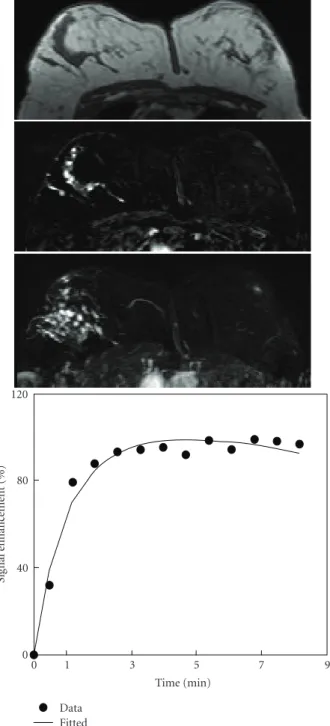 Figure 5: A 47-year-old woman with high-grade pure DCIS. Axial precontrast T1-weighted image (top), postcontrast subtraction image (middle), and maximum intensity projection (bottom) show a Nonmass-like lesion with ductal clumped enhancement pattern in the