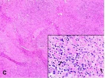 FIG. 2-1. Idiopathic orbital myositis with severe muscle destruction 