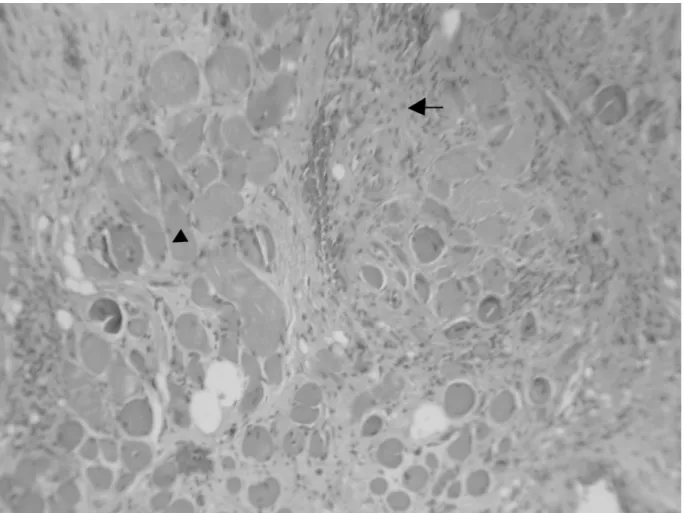Figure 4-3. Effect of IL1-Ra on the muscle after myositis induction in pathology  finding one week after phobal ester injection