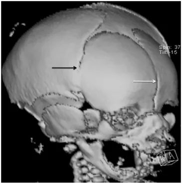 Fig. 6. Three-dimensional computed tomography scans of the skull shows premature synostosis of the metopic and coronal sutures.