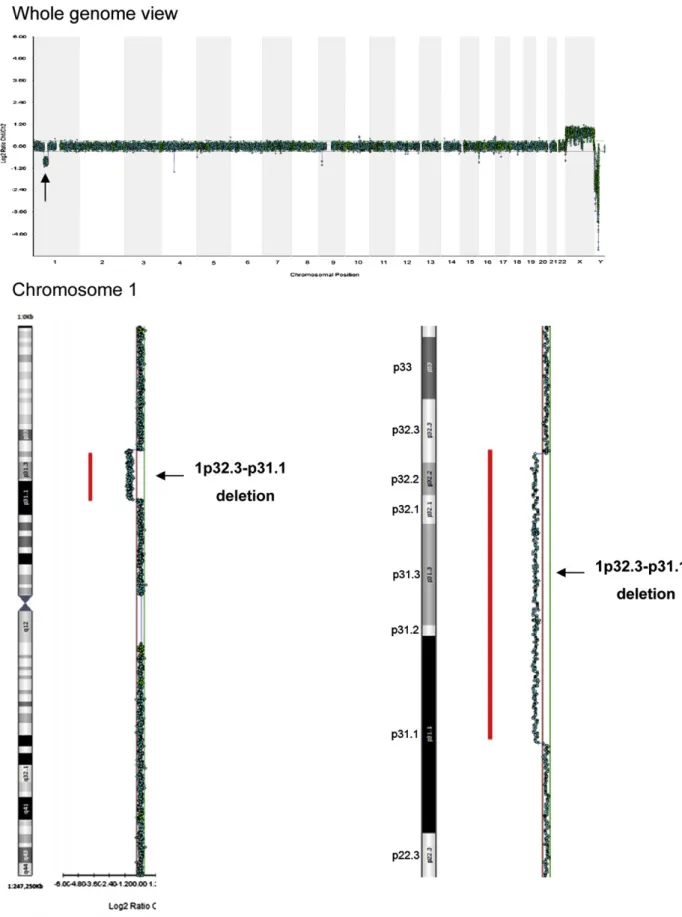 Fig. 3. Oligonucleotide-based array comparative genomic hybridization shows a 22.2-Mb deletion from 1p32.3 to 1p31.1 [arr cgh 1p32.3p31.1 (55,500,291e77,711,982)1] (arrow)