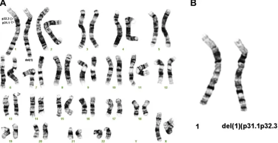 Fig. 5. Fluorescence in situ hybridization using bacterial artificial chromosome clone probes RP11-31P4 (61,339,876 e61,527,391 bp) (spectrum red) at 1p31.3 encompassing the NFIA gene and RP11-438F14 (spectrum green) at 1q44 as internal control shows absen