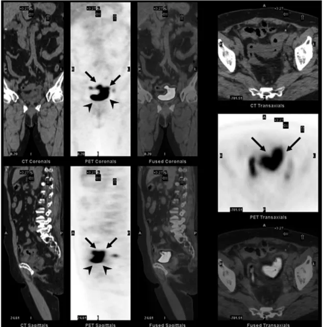 FIGURE 2. Under the impression of recurrent cervical cancer, FDG PET/CT was performed for whole-body cancer work-up