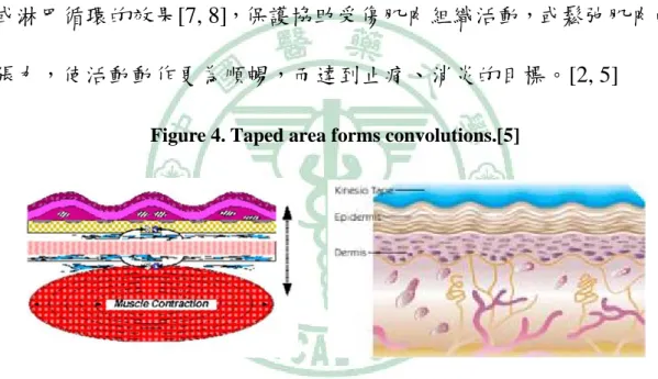 Figure 4. Taped area forms convolutions.[5] 