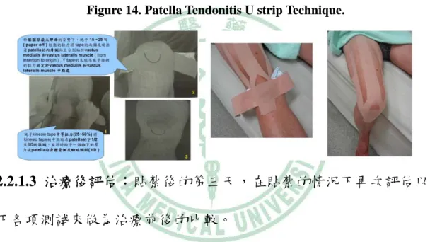 Figure 14. Patella Tendonitis U strip Technique. 