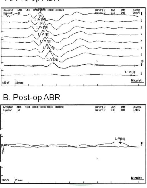 Figure 2.6 ABR threshold changes before and after the disruption of labyrinthine  artery