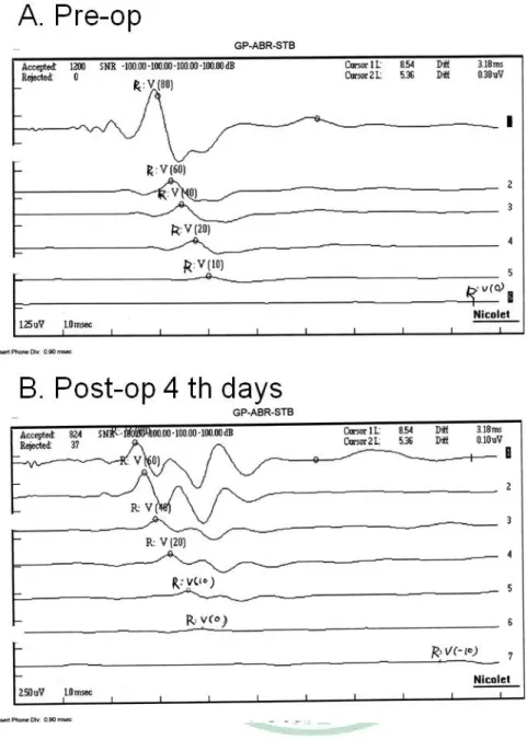 Figure 2.7 Hearing level in sham surgery. Compared with the ABR waveform and  auditory level before the surgery (A), no obvious auditory threshold shifts was noted 4  days after the surgery (B)