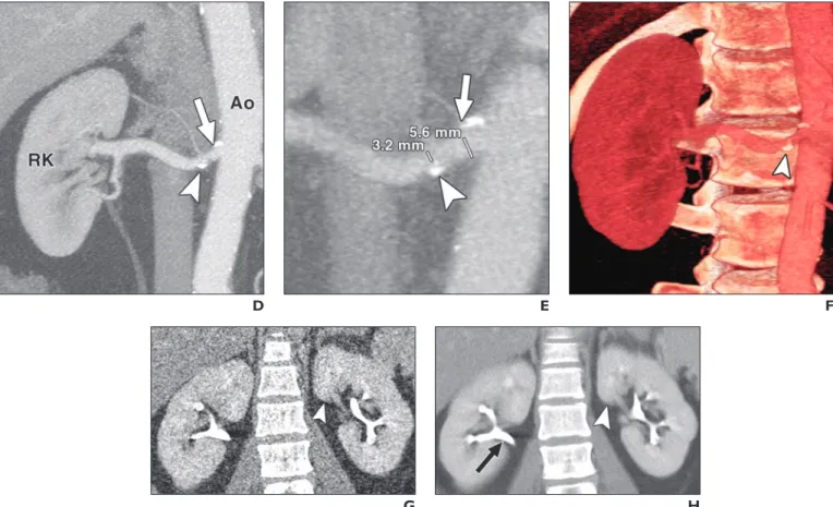 Fig. 1 (continued)—46-year-old man with resistant hypertension who underwent renal artery stenosis survey
