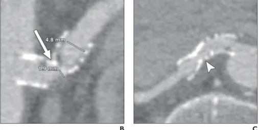 Fig. 4 (continued)—24-year-old woman (same patient  as in Figure 3) who underwent bilateral renal artery  stenting for treatment of fibromuscular dysplasia.