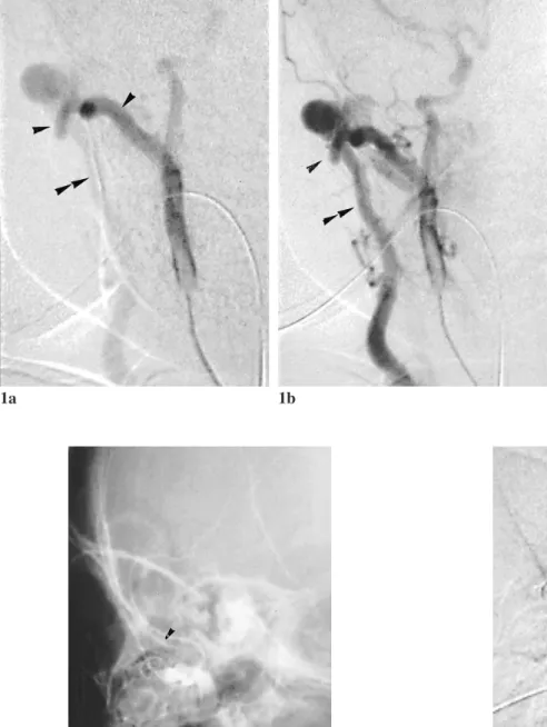 Figure 3. Lateral projection of right external carotid angiogram after embolization shows complete occlusion of the fistula.