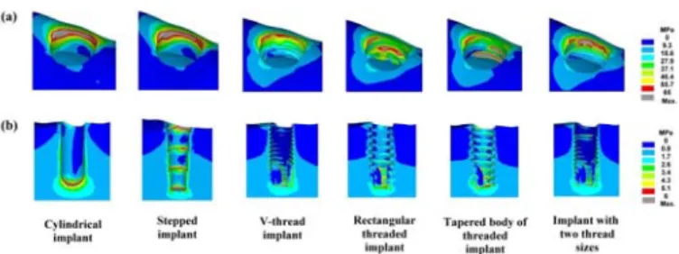 Fig. 1. von-Mises stress distributions in cortical bone  (a) and trabecular bone (b) in models with  μ  = 0.4 at  the BII under lateral loading