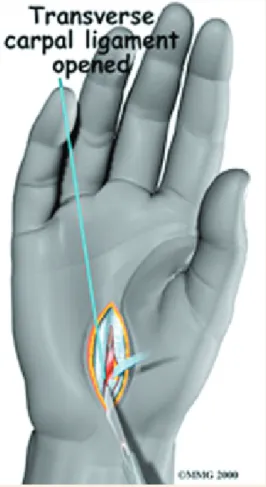 圖 5： 腕隧道症候群的手術方式之一：直接切開橫 韌帶 圖 6： 腕隧道症候群手術方式之二：內視鏡手術切 開橫韌帶開刀治療的程度。但是，這樣的電刺激可能會令病患不適，所以通常是先按臨床症狀來診斷並治療。治療方式腕隧道症候群的治療方式，包括：藥物治療、副木輔具的使用、讓手腕充分休息、復健治療及手術治療等，因症狀而有不同選擇。由於腕隧道症候群主要是手腕過度使用或勞累所造成，當症狀輕微，不影響日常生活時，以休息及日常生活保護最為重要，只要減少腕部不當的姿勢及重複性動作，避免腕部過度勞累即可。如果休息也無法減輕症狀