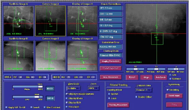 Figure 1. The Synchrony ®  Respiratory Tracking System (RTS) for lung SBRT: 