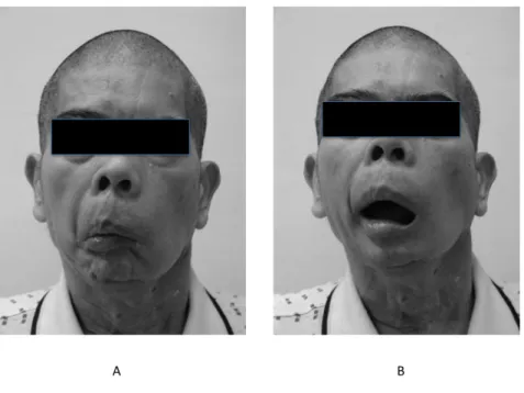 Figure 2. A. The patient could not open his mouth spontaneously before operation. B. The  increasing mouth opening was achieved gradually after operation