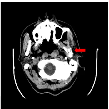 Figure  3.  Post-operation  CT  image:  The  followed  CT  revealed  bilateral  normal  zygomatic  arch  of  temporomandibular  joint  without  evidence  of  recurrence  one  (arrow)  month  after  operation   
