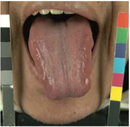 圖 3-2 舌質淡紅、舌苔薄白           圖 3-3 舌質紅、舌苔白膩 