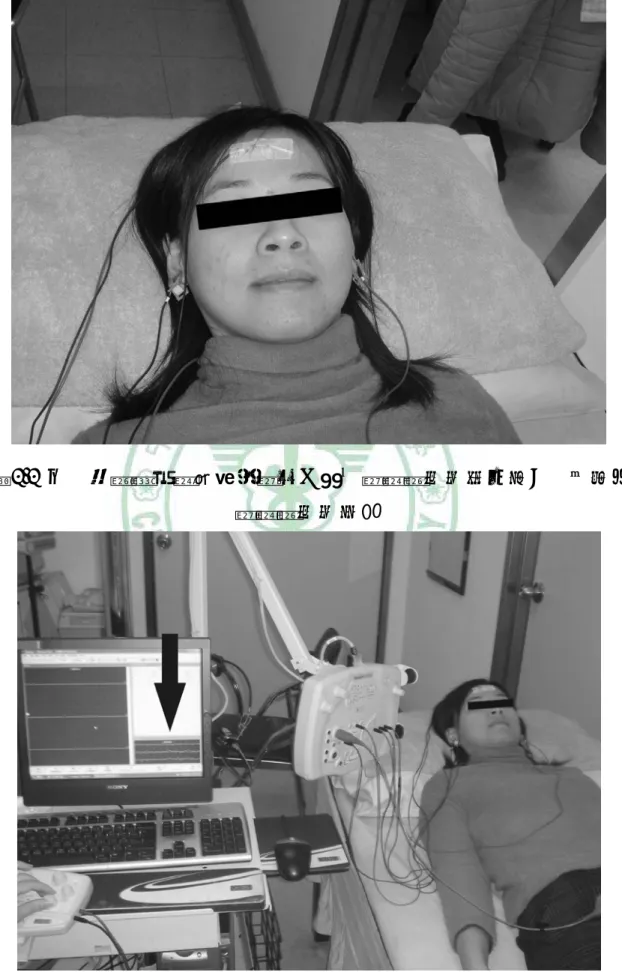 圖 3.3  正中神經體性感覺誘發電位之參考電極置放於兩耳垂上，而接地 電極置放於前額 