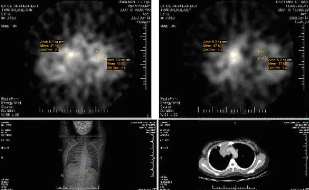 圖 一 、 真 陽 性 病 例 ：右上肺葉肺腺癌(左右下圖為電腦斷層攝影  影像，顯示病灶所在)，在 201 Tl SPECT 早期(左上圖)晚期(右上  圖)均有顯影，而且晚期顯影增強，滯留指數為 102.42%。 