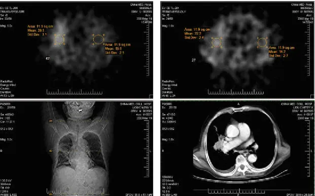 圖 二 、 真 陰 性 病 例 ：右側肺門處肺結核病灶(左右下圖為電腦斷  層攝影影像，顯示病灶所在)，在 201 Tl SPECT 晚期顯影(右上  圖)較早期顯影(左上圖)為弱，滯留指數為-37.62%。 
