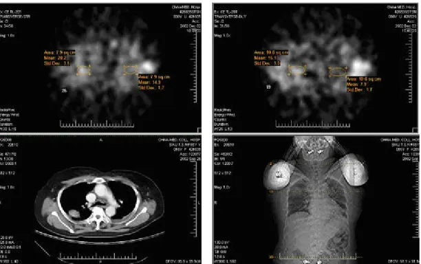 圖 四 、 偽 陽 性 病 例 ：右上肺葉肺結核病灶(左右下圖為電腦斷層  攝影影像，顯示病灶所在)，在 201 Tl SPECT 晚期顯影(右上圖)  強於早期顯影(左上圖)，滯留指數為 40.99%。 