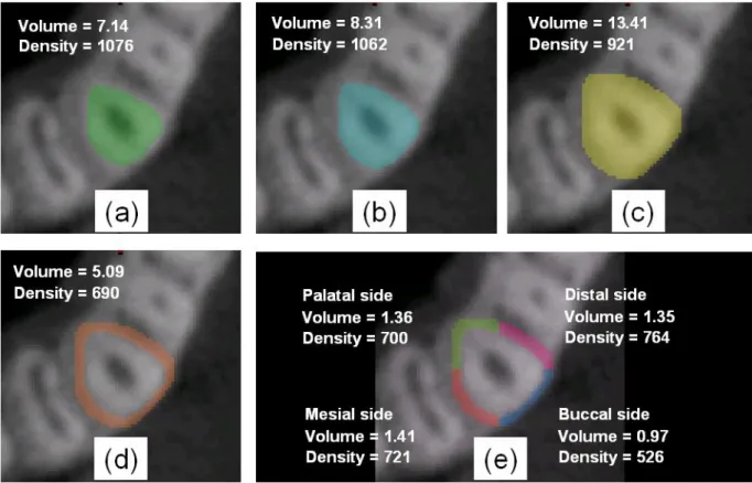 Figure 2. Steps involved in measuring the bone density around the upper-left canine in the middle  slice at the intermediate level in patient #2: (a) segmenting the area of the tooth from the CBCT  image using the threshold value of the cementum; (b) expan