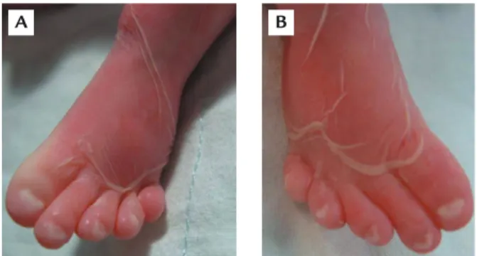 Figure 3. Malposition of the toes with hypoplastic nails in proband 1.