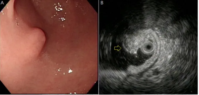 Figure 1. Ectopic pancreas originates from the second and third sonographic layers of the gastric wall