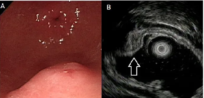Figure 2. Ectopic pancreas originates from the second and third sonographic layers of the gastric wall