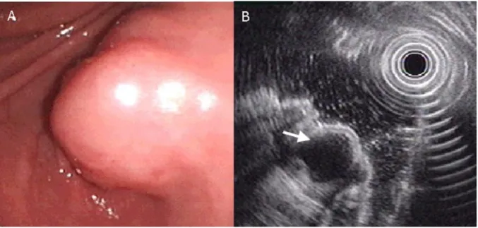 Figure 3. Ectopic pancreas originates from the fourth sonographic layers of the gastric wall.